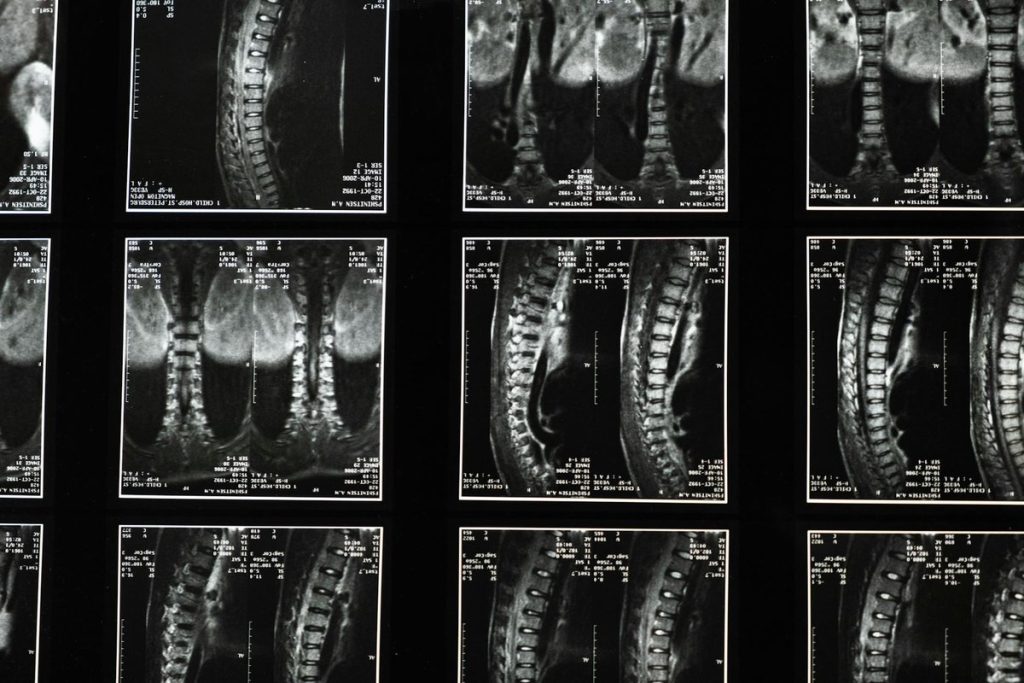 séquelle après arthrodèse lombaire