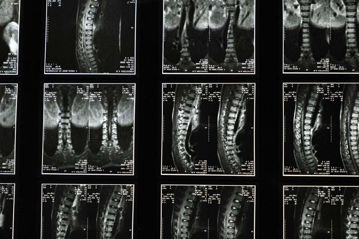 séquelle après arthrodèse lombaire