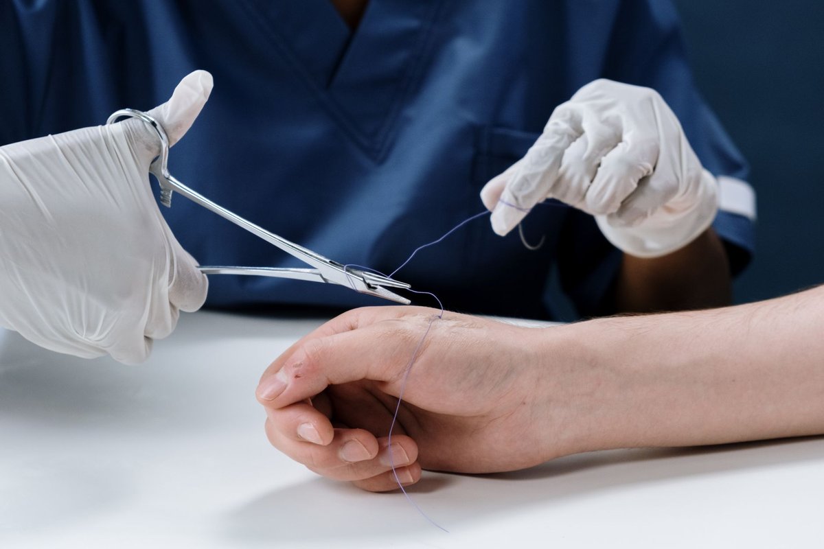 point de suture résorbable : combien de temps