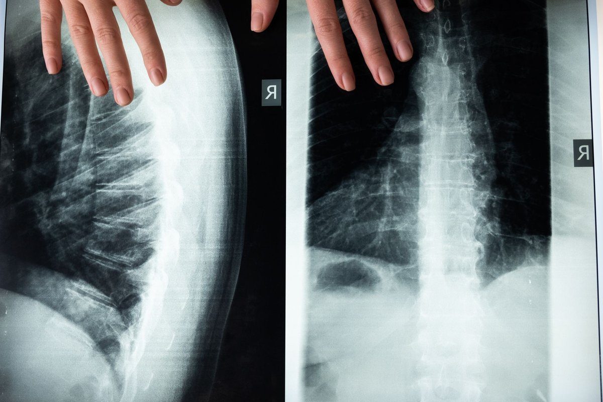 arthrodèse lombaire : récupération