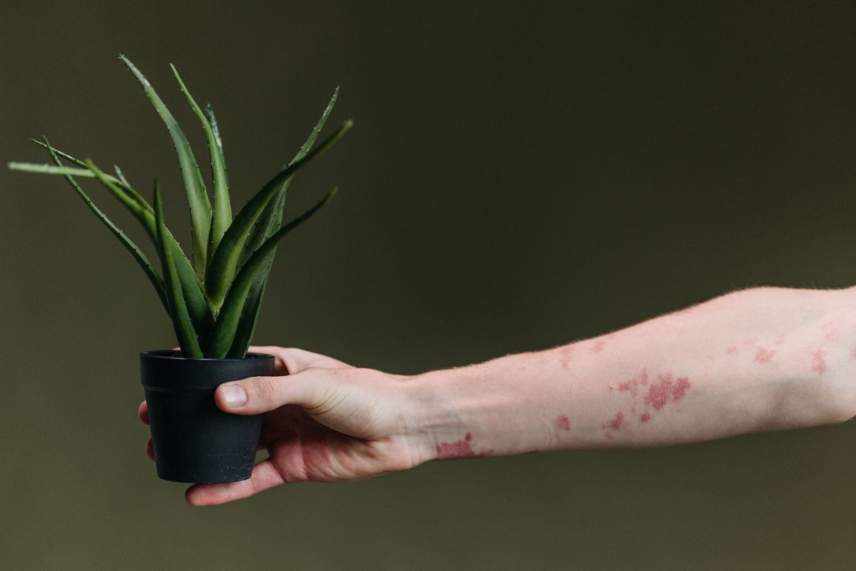 eczema : causes