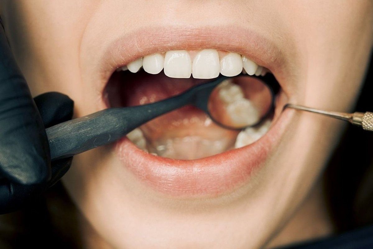 gingivite : traitement naturel