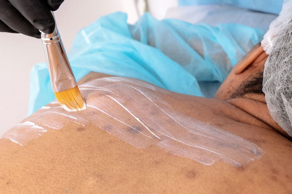 psoriasis : quel traitement