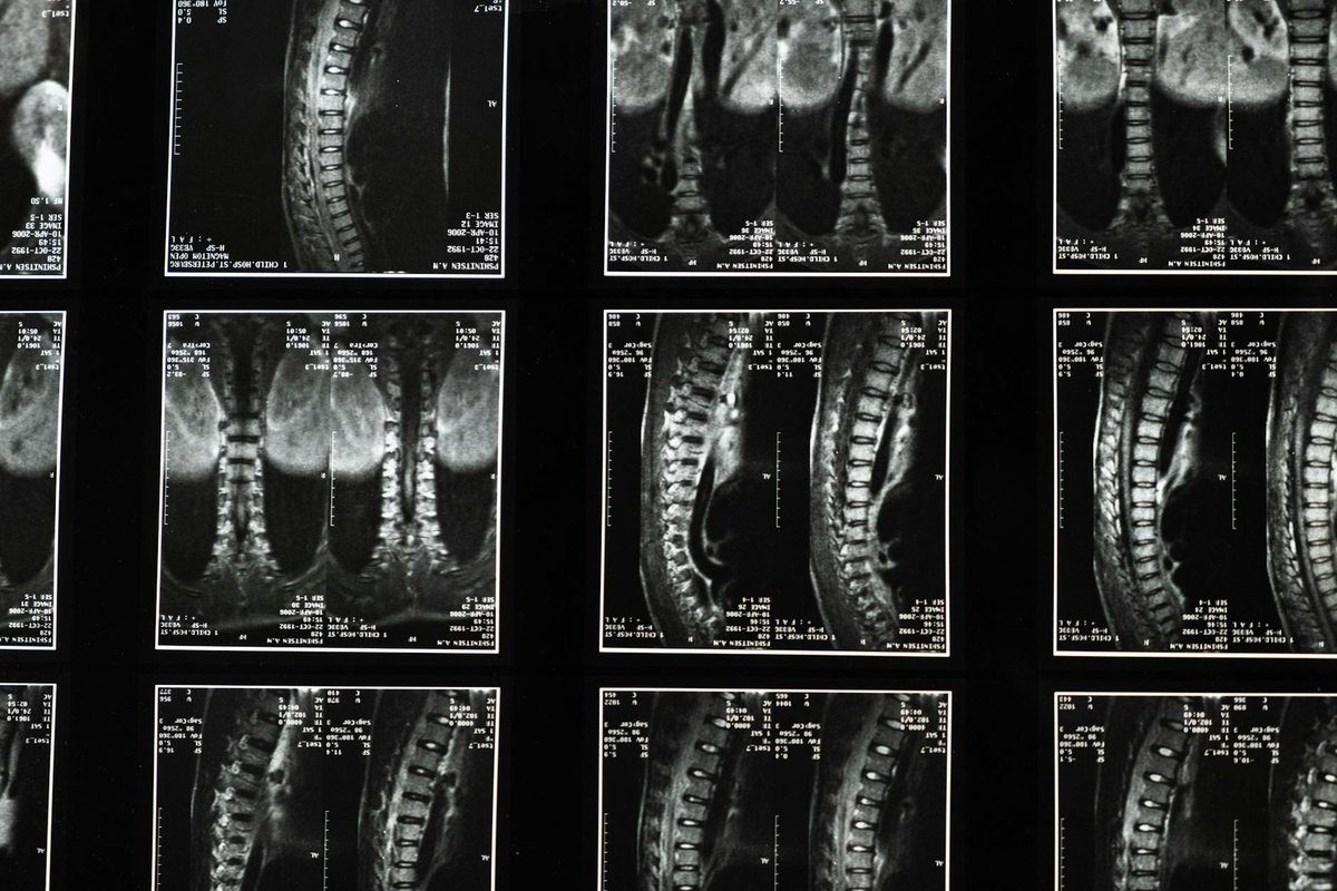 séquelle après arthrodèse lombaire